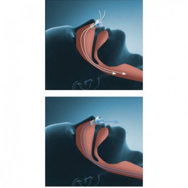 Horlama Önleyici Rahat Uyku Aparatı 